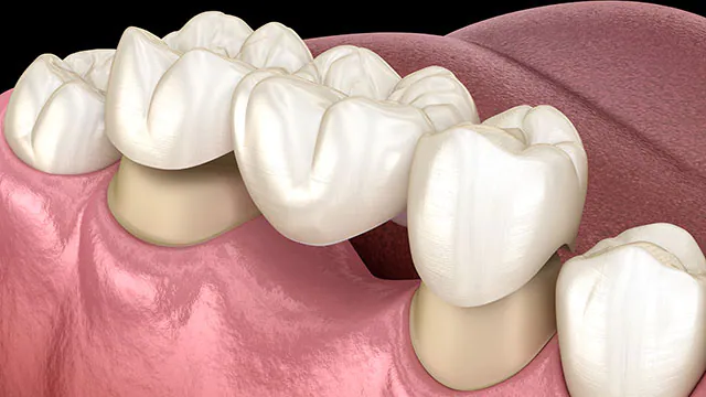 Dental Crowns and Bridges