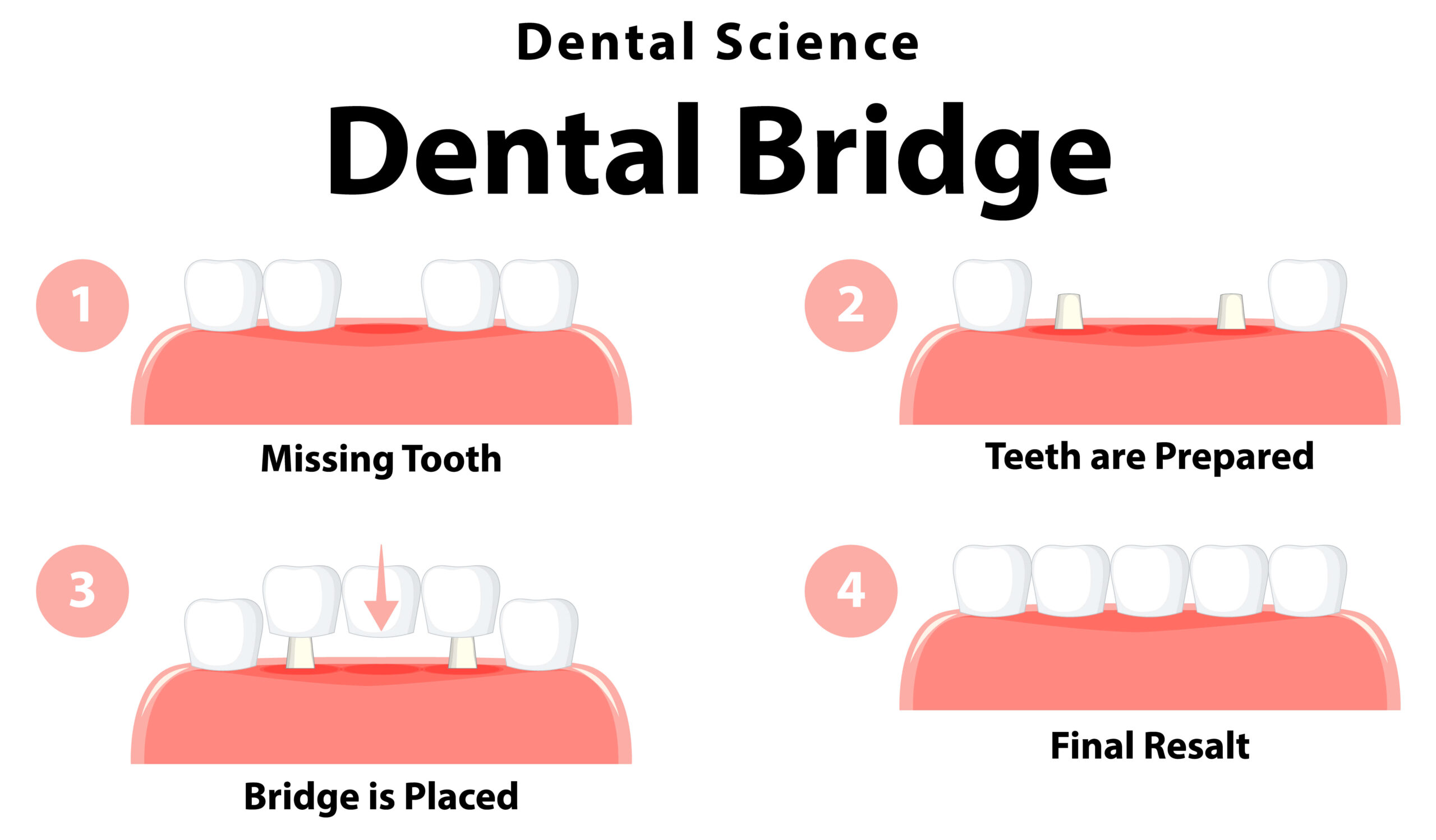 Dental crowns and bridges