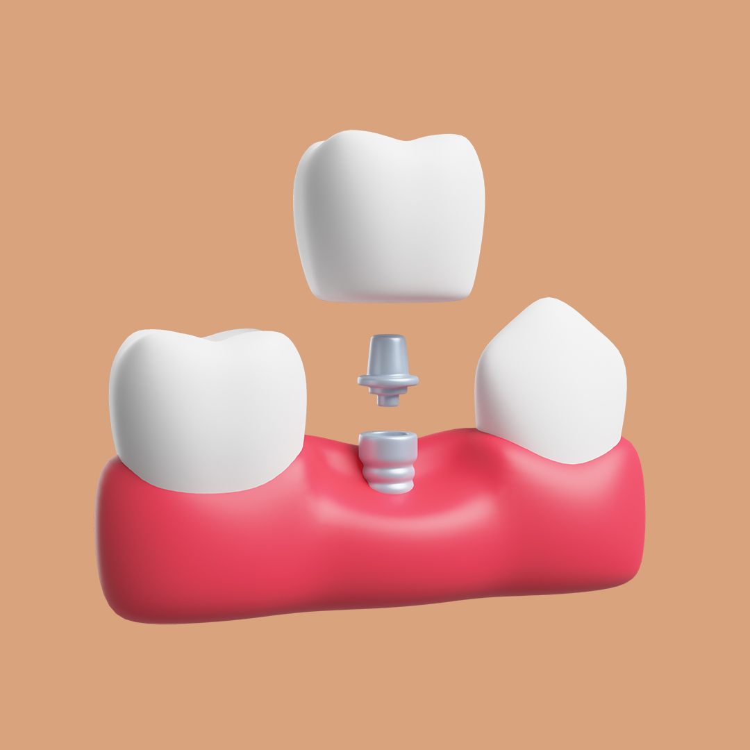 Get Dental Implants in Kampala, Uganda