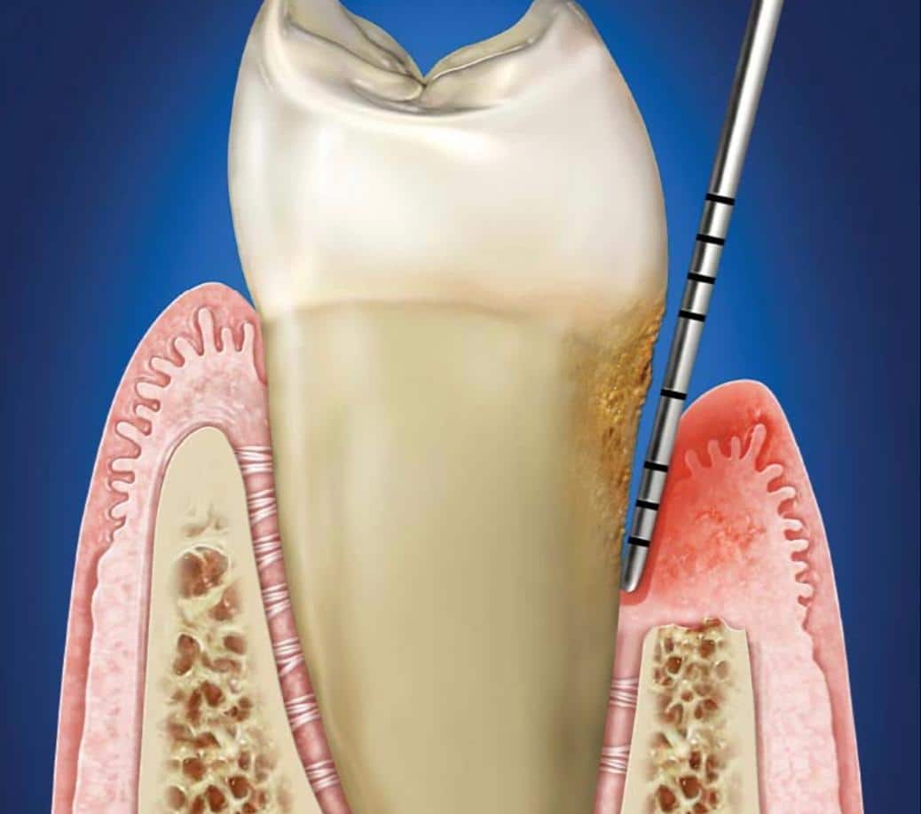 Gum Dental Disease