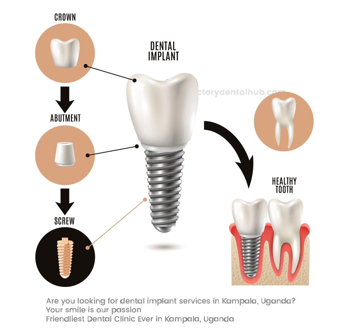 When Do You Need a Dental Implant? Implants are the best option for replacing an entire tooth, including the root.