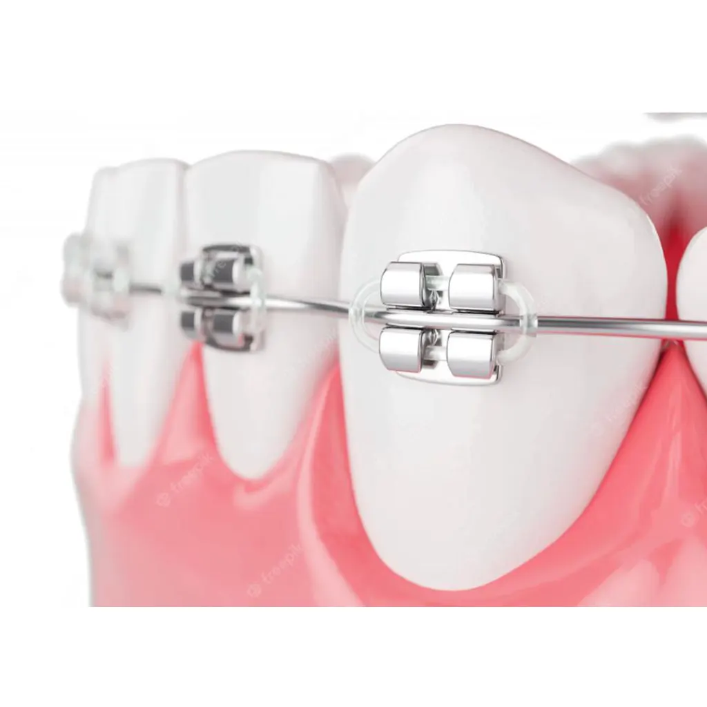 Orthodontic treatment (usually with braces)