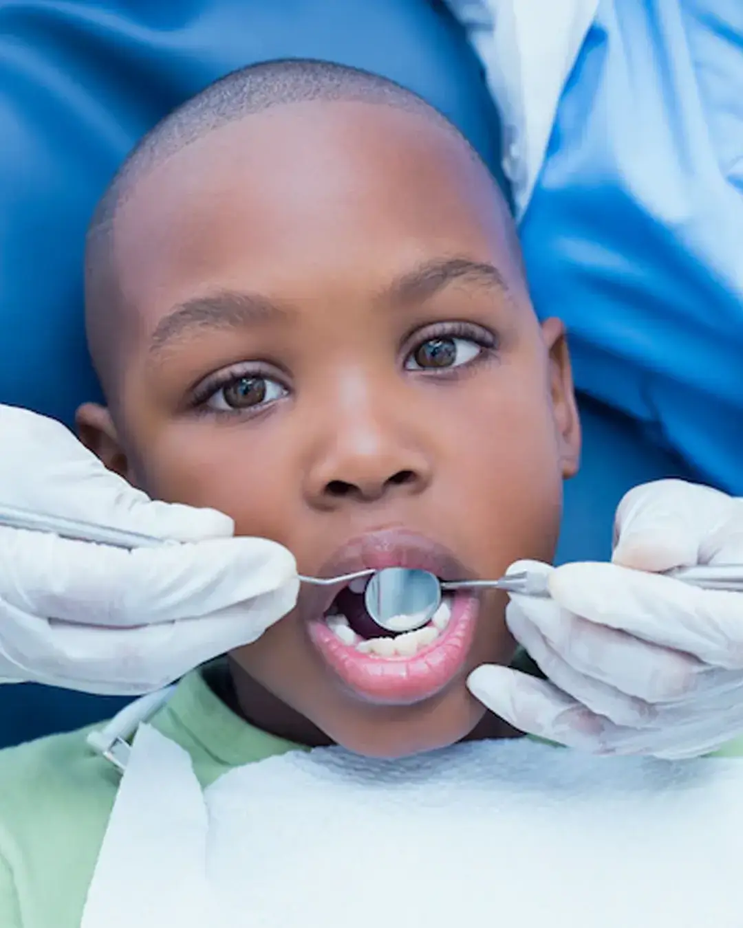Pulpectomy: Root canal treatment for the baby's teeth in Kampala