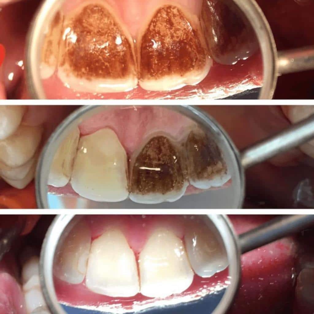 Professional dental scaling and polishing in Kampala