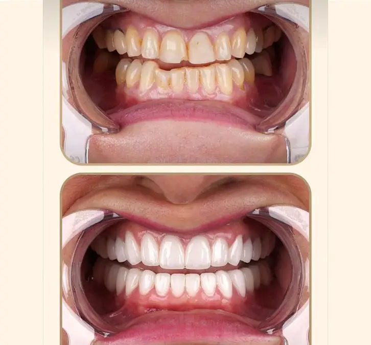 Scaling and polishing