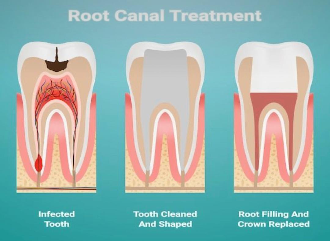 ROOT CANAL Treatments