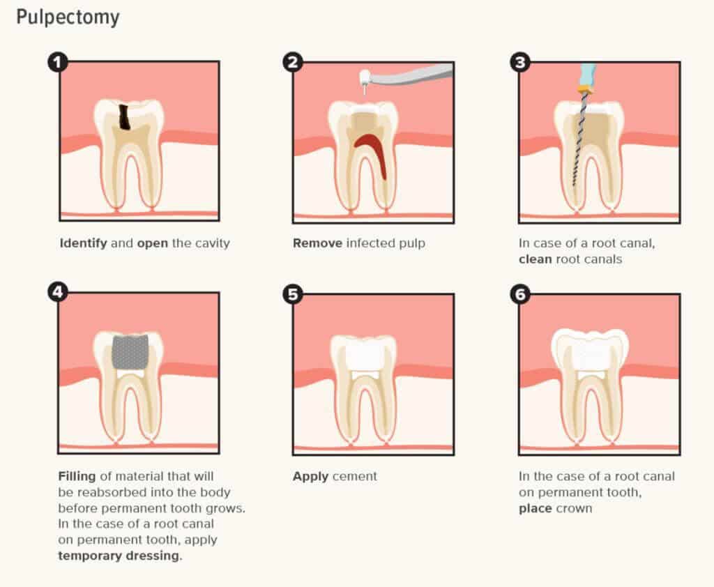 Root canal treatment for the baby teeth