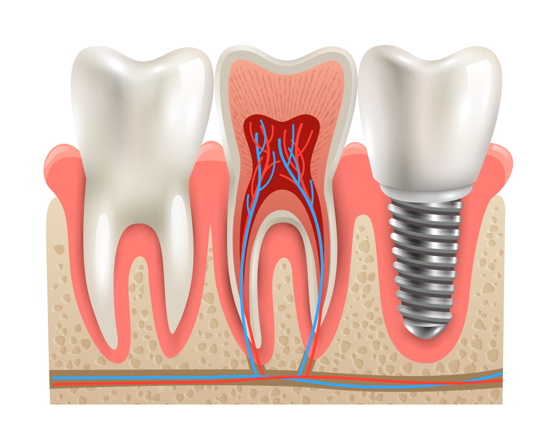 Specialized Dental Implant Practice in Uganda