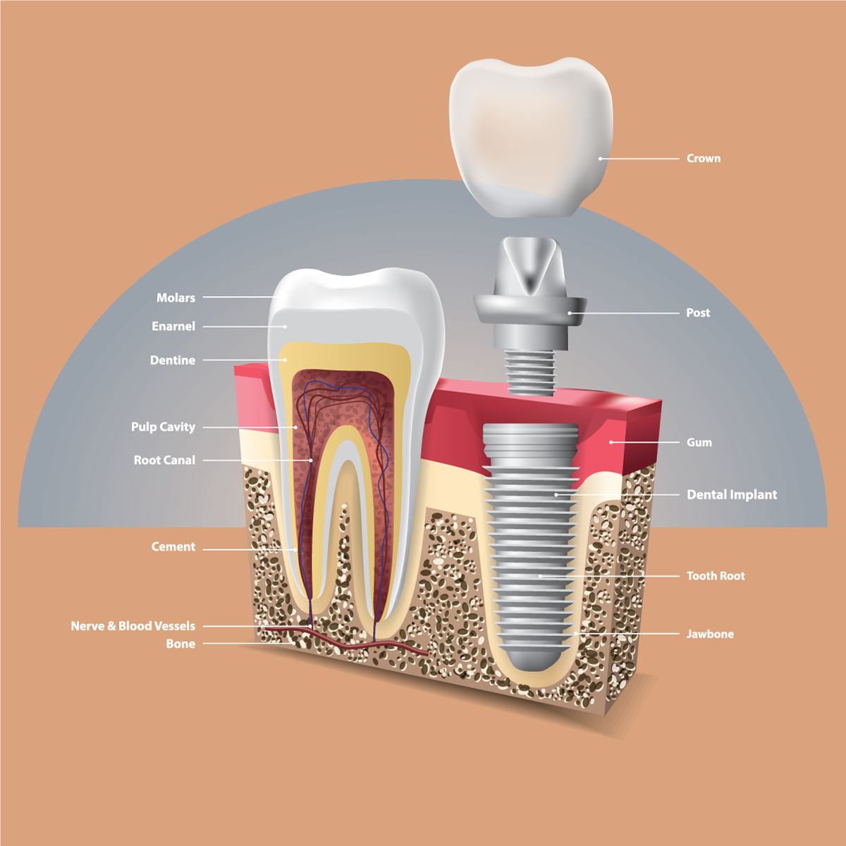 dental-implant