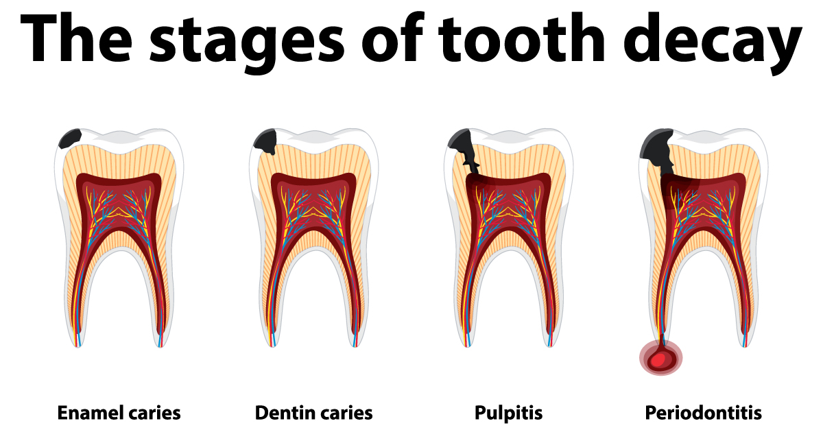 https://www.victorydentalhub.com/wp-content/uploads/2023/09/human-in-the-stages-of-tooth-decay.jpg