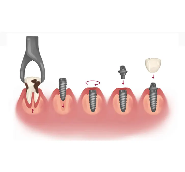 Dental Implants is the branch of dentistry that deals with the permanent implantation of artificial teeth in the jaw.  Dental Service in Kampala