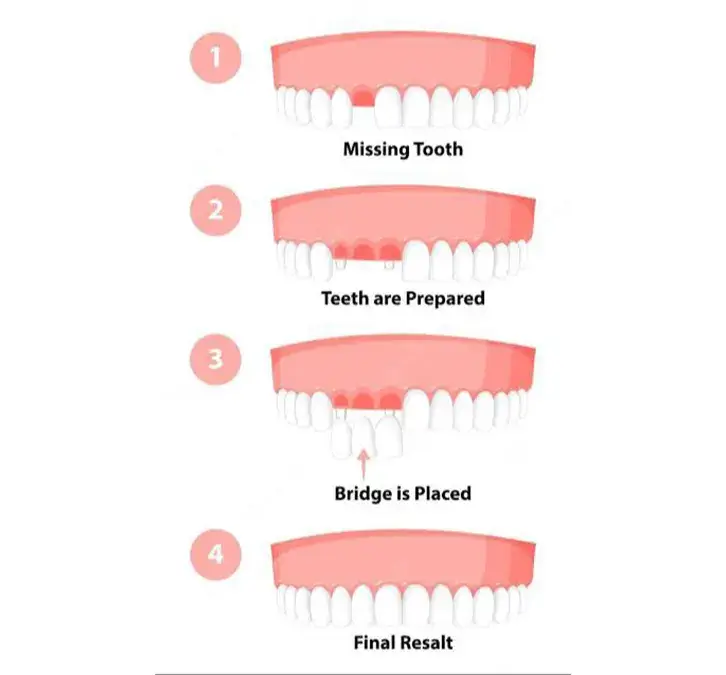  Artificial teeth (Prosthodontics): 