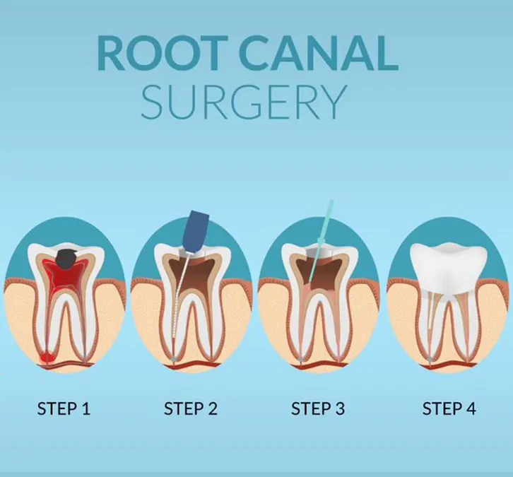 Root canal treatment Endodontics in Kampala Uganda