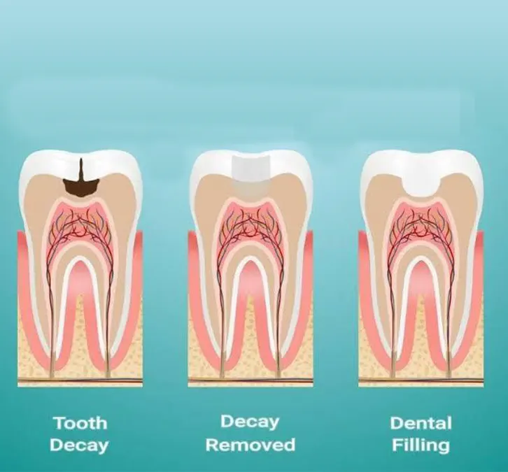 Conservative dentistry Dental Service in Kampala